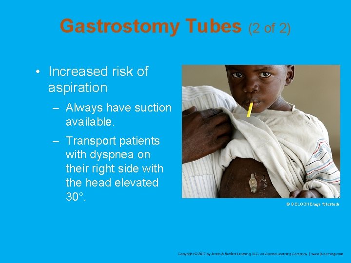 Gastrostomy Tubes (2 of 2) • Increased risk of aspiration – Always have suction