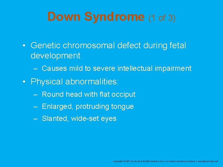 Down Syndrome (1 of 3) • Genetic chromosomal defect during fetal development – Causes