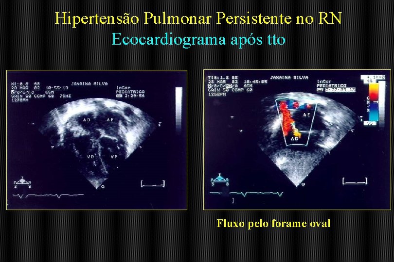 Hipertensão Pulmonar Persistente no RN Ecocardiograma após tto Fluxo pelo forame oval 