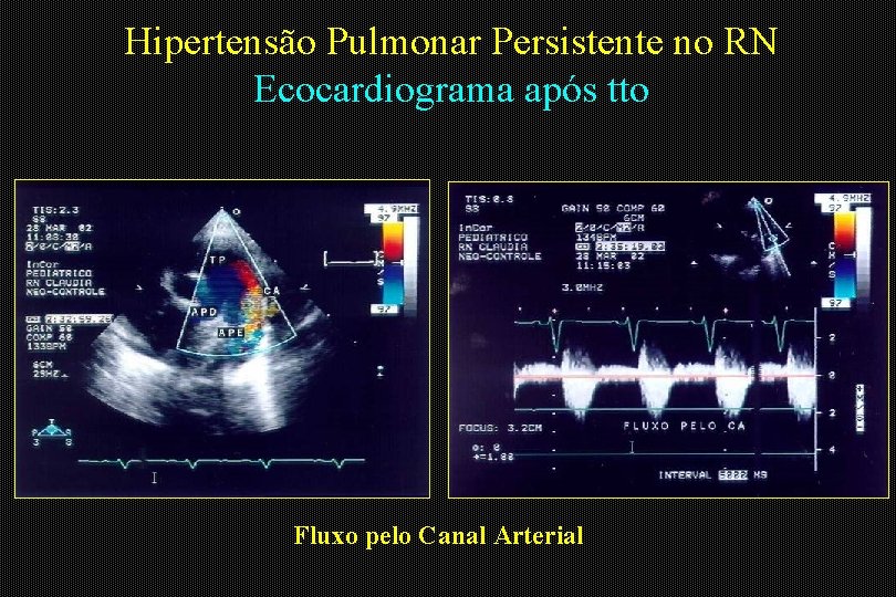 Hipertensão Pulmonar Persistente no RN Ecocardiograma após tto Fluxo pelo Canal Arterial 