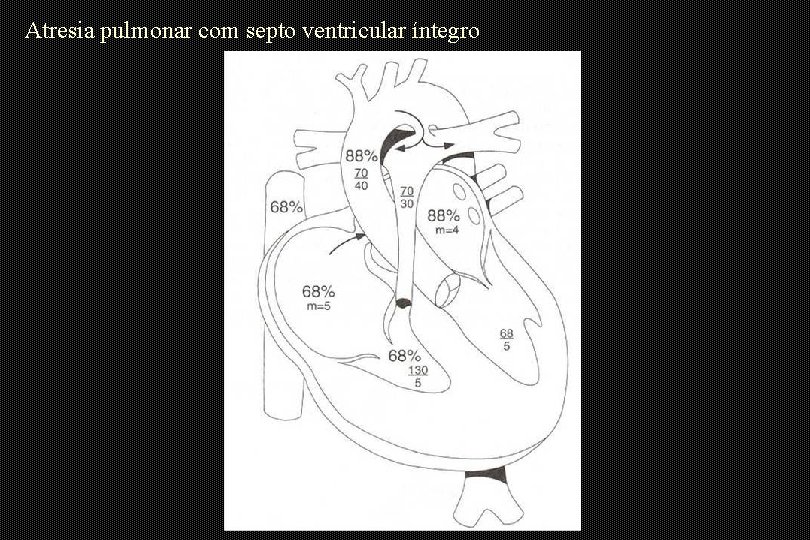 Atresia pulmonar com septo ventricular íntegro 