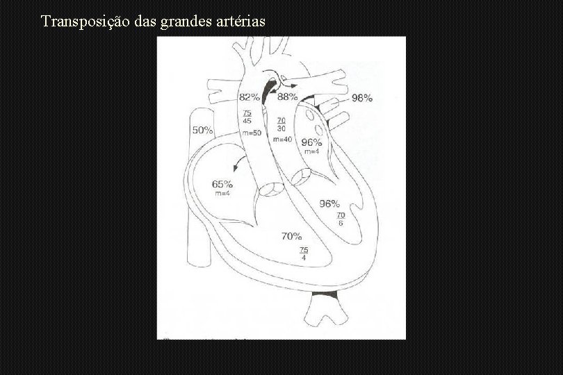 Transposição das grandes artérias 