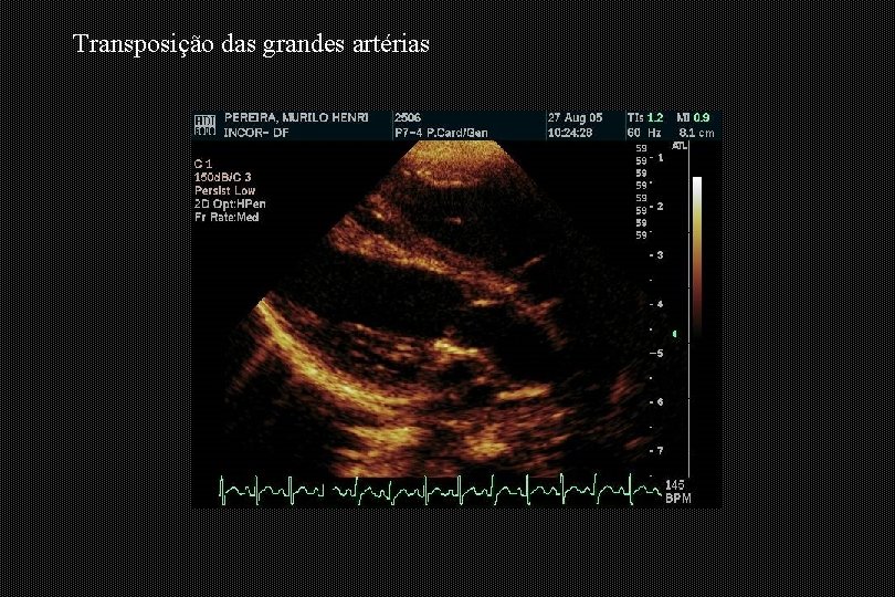 Transposição das grandes artérias 