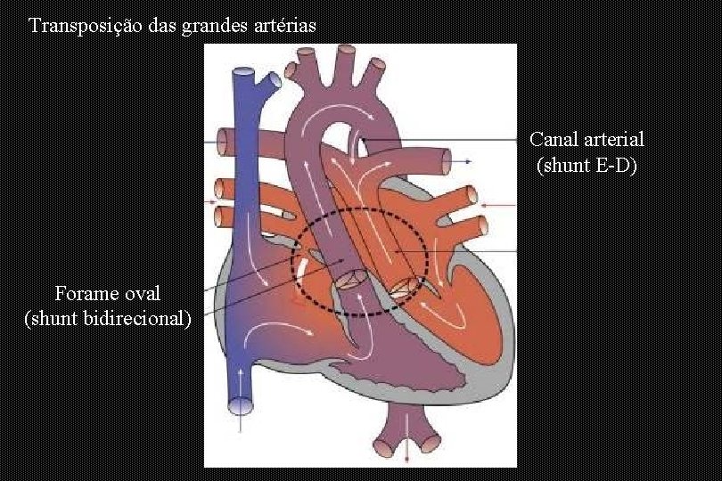 Transposição das grandes artérias Canal arterial (shunt E-D) Forame oval (shunt bidirecional) 