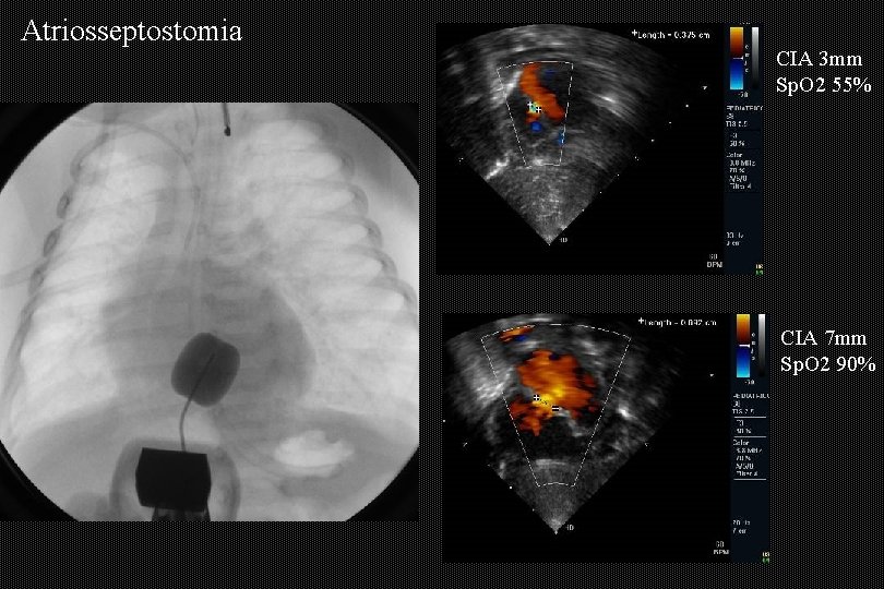 Atriosseptostomia CIA 3 mm Sp. O 2 55% CIA 7 mm Sp. O 2