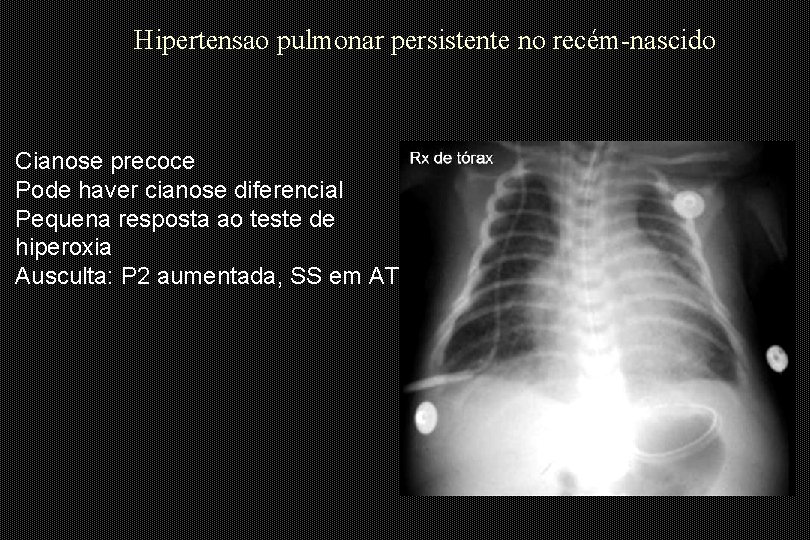 Hipertensao pulmonar persistente no recém-nascido Cianose precoce Pode haver cianose diferencial Pequena resposta ao