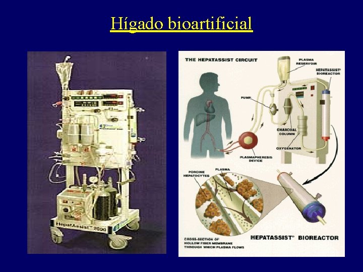 Hígado bioartificial 