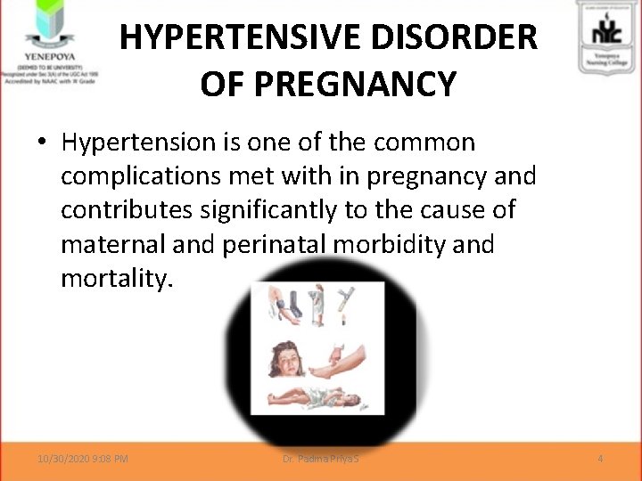  • HYPERTENSIVE DISORDER OF PREGNANCY Hypertension is one of the common complications met