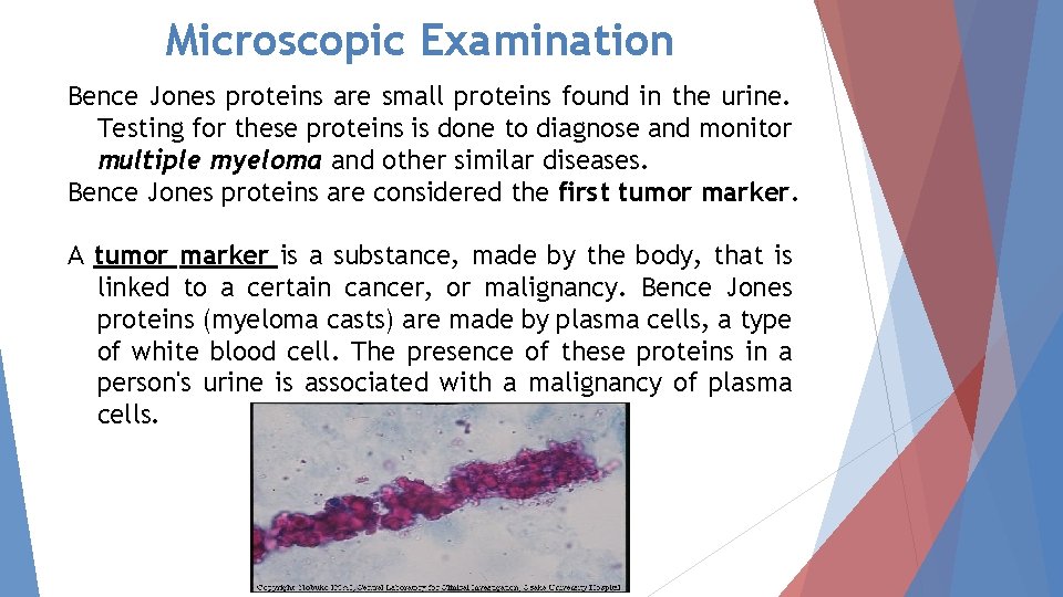 Microscopic Examination Bence Jones proteins are small proteins found in the urine. Testing for