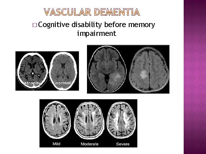 � Cognitive disability before memory impairment 