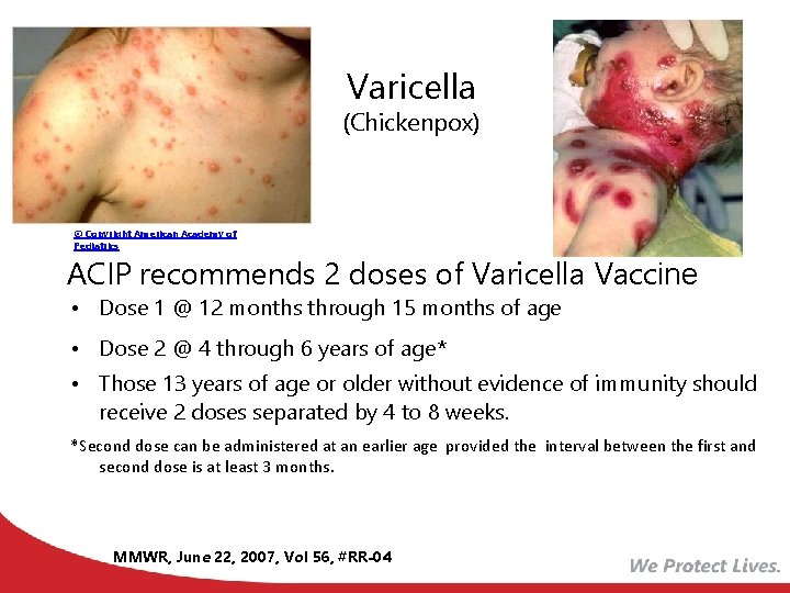Varicella (Chickenpox) © Copyright American Academy of Pediatrics ACIP recommends 2 doses of Varicella