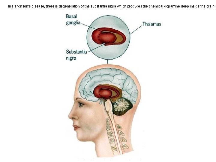 In Parkinson’s disease, there is degeneration of the substantia nigra which produces the chemical