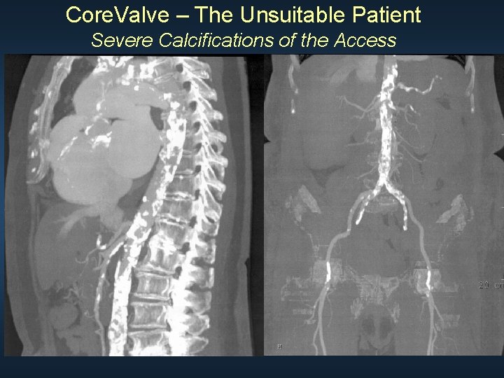 Core. Valve – The Unsuitable Patient Severe Calcifications of the Access 