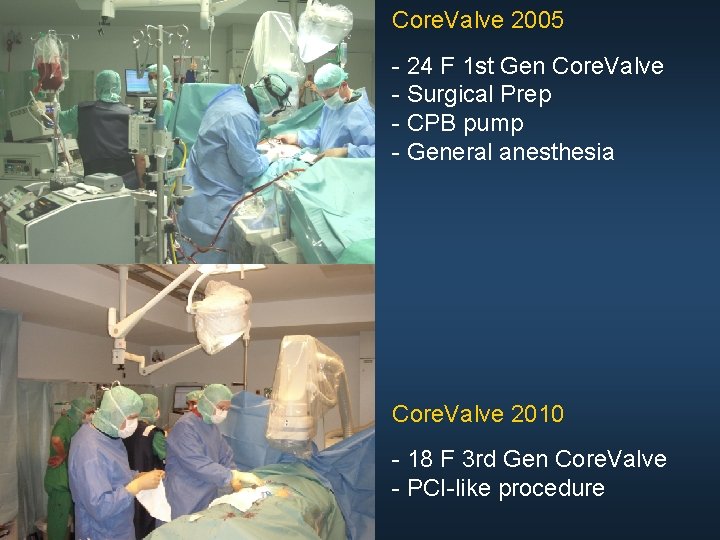 Core. Valve 2005 - 24 F 1 st Gen Core. Valve - Surgical Prep