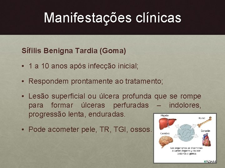 Manifestações clínicas Sífilis Benigna Tardia (Goma) • 1 a 10 anos após infecção inicial;