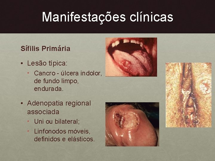 Manifestações clínicas Sífilis Primária • Lesão típica: • Cancro - úlcera indolor, de fundo