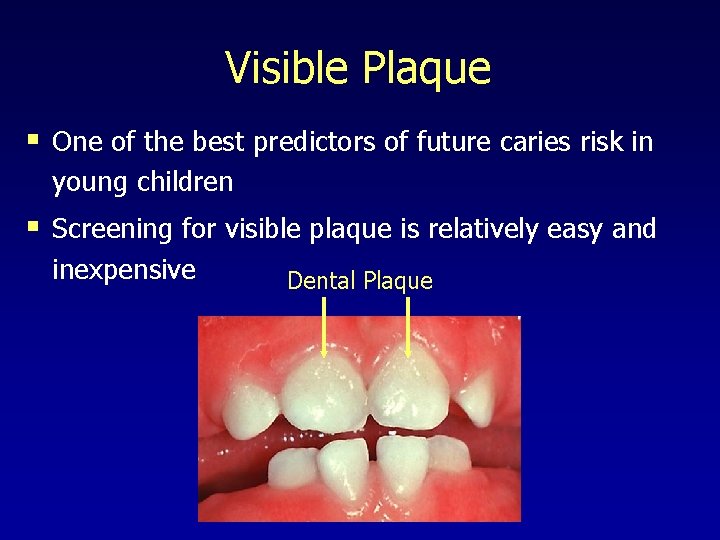 Visible Plaque § One of the best predictors of future caries risk in young