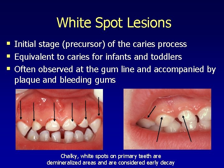 White Spot Lesions § Initial stage (precursor) of the caries process § Equivalent to