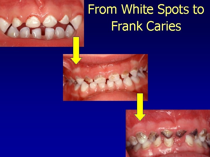 From White Spots to Frank Caries 