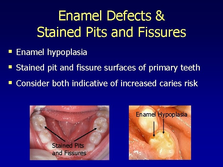 Enamel Defects & Stained Pits and Fissures § Enamel hypoplasia § Stained pit and