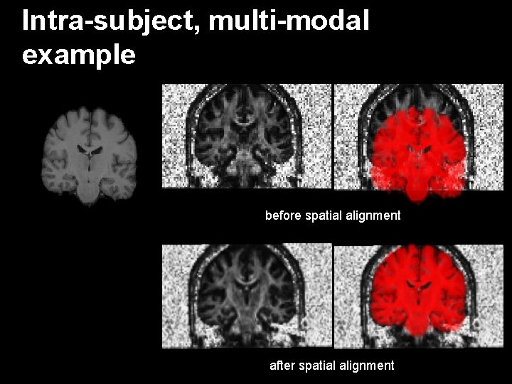 Intra-subject, multi-modal example before spatial alignment after spatial alignment 