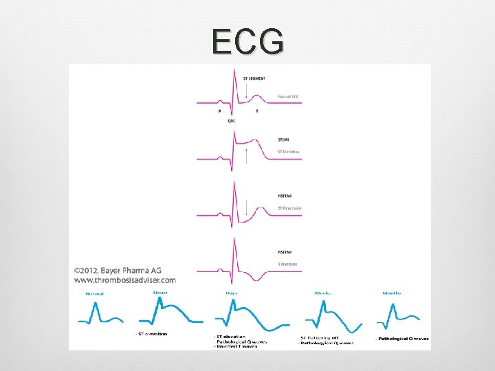 ECG ECG