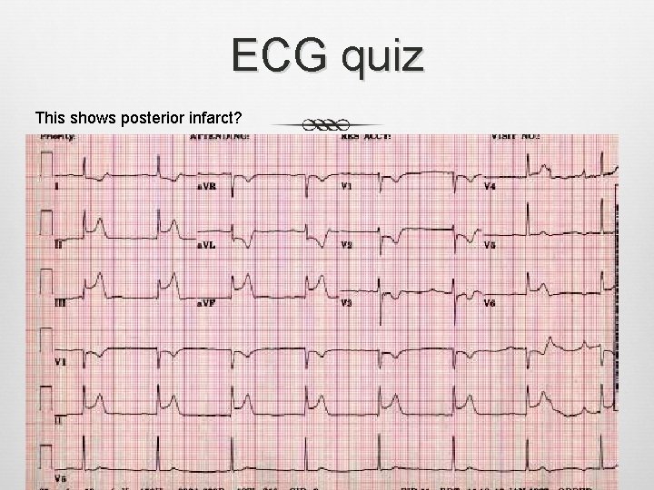 ECG quiz This shows posterior infarct? ECG quiz This shows posterior infarct?