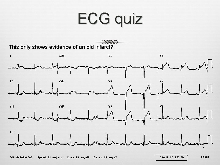 ECG quiz This only shows evidence of an old infarct? ECG quiz This only shows evidence of an old infarct?