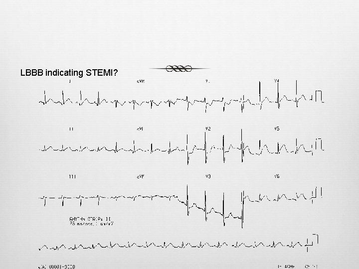 LBBB indicating STEMI? LBBB indicating STEMI?