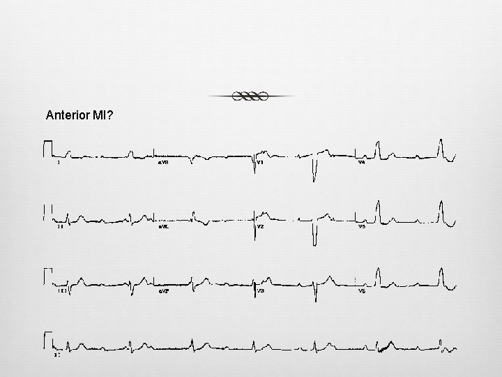 Anterior MI? Anterior MI?