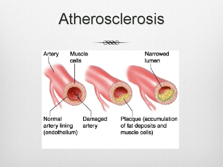 Atherosclerosis Atherosclerosis