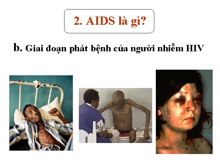 2. AIDS là gì? b. Giai đoạn phát bệnh của người nhiễm HIV 