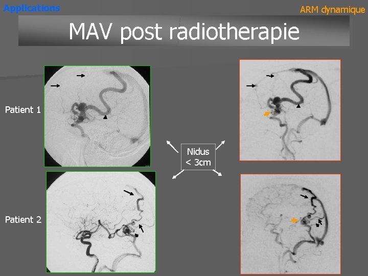 Applications ARM dynamique MAV post radiotherapie Patient 1 Nidus < 3 cm Patient 2