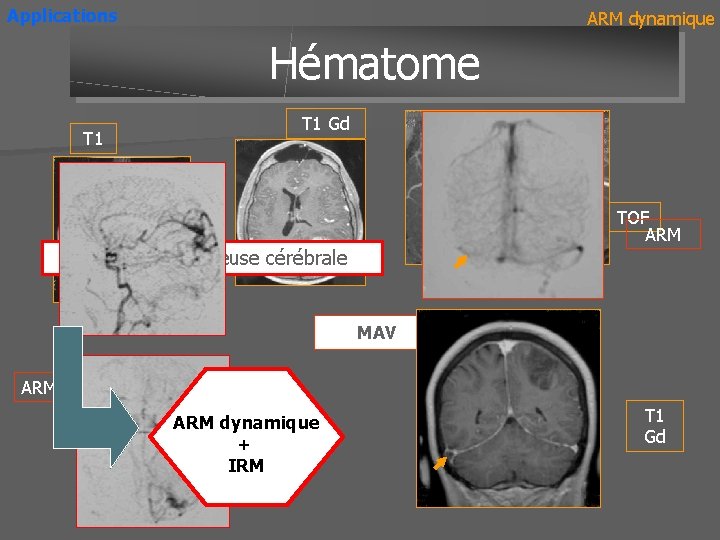 Applications ARM dynamique Hématome T 1 Gd TOF ARM Thrombose veineuse cérébrale MAV ARM
