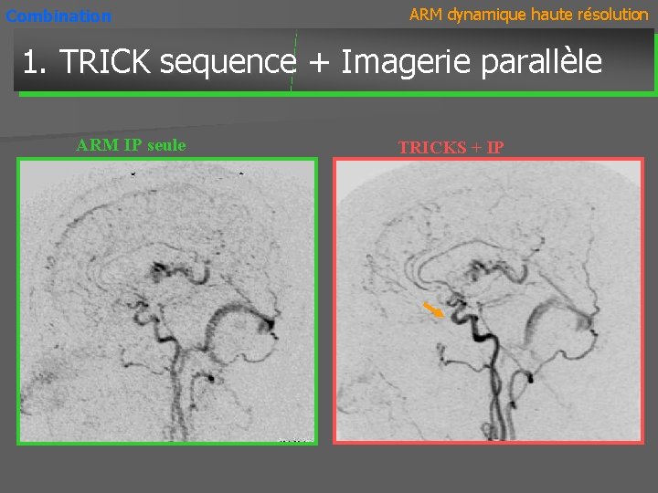 Combination ARM dynamique haute résolution 1. TRICK sequence + Imagerie parallèle ARM IP seule