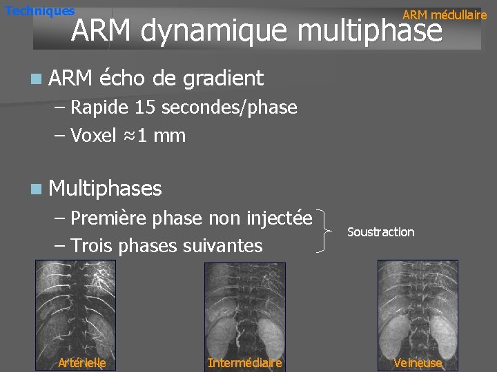 Techniques ARM médullaire ARM dynamique multiphase n ARM écho de gradient – Rapide 15