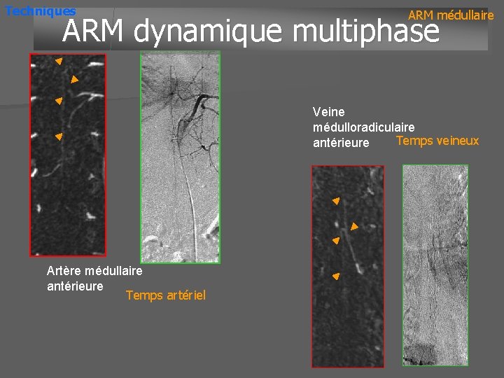 Techniques ARM médullaire ARM dynamique multiphase Veine médulloradiculaire Temps veineux antérieure Artère médullaire antérieure