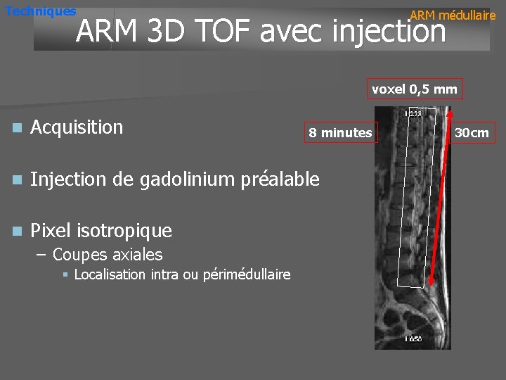 Techniques ARM médullaire ARM 3 D TOF avec injection voxel 0, 5 mm n