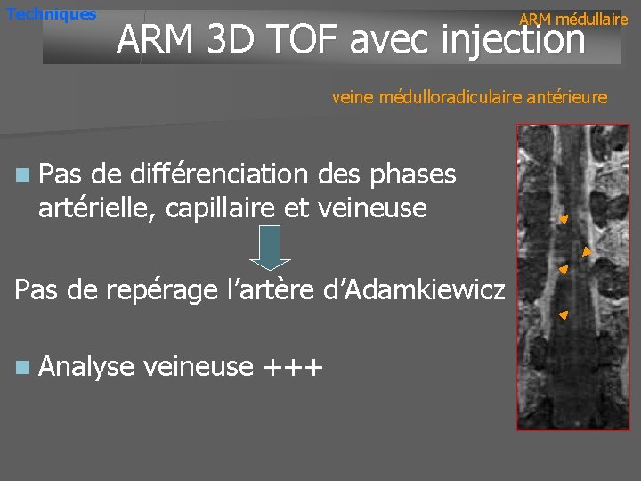 Techniques ARM médullaire ARM 3 D TOF avec injection veine médulloradiculaire antérieure n Pas