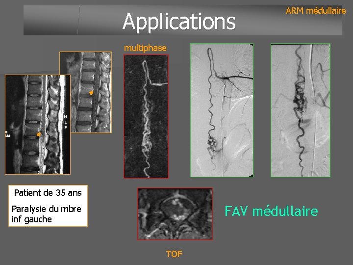 Applications ARM médullaire multiphase Patient de 35 ans Paralysie du mbre inf gauche FAV