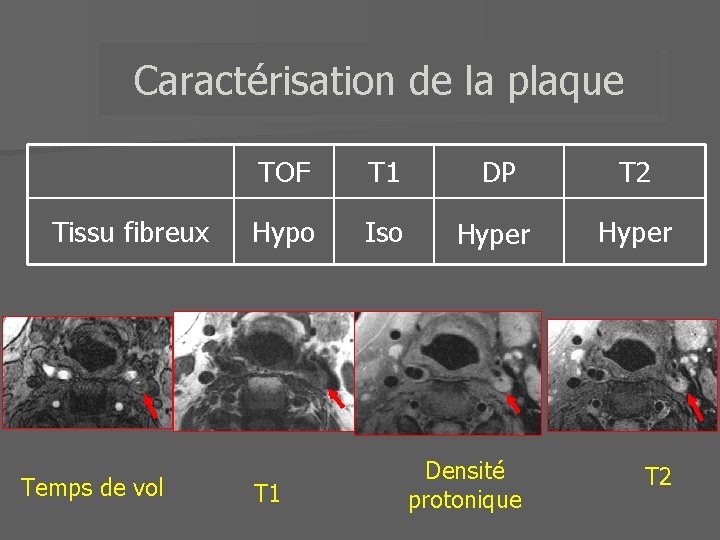 Caractérisation de la plaque Tissu fibreux Temps de vol TOF T 1 DP T