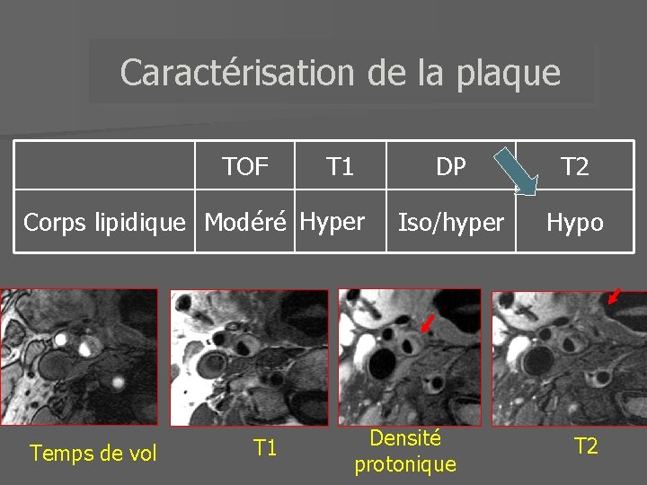 Caractérisation de la plaque TOF T 1 Corps lipidique Modéré Hyper Temps de vol