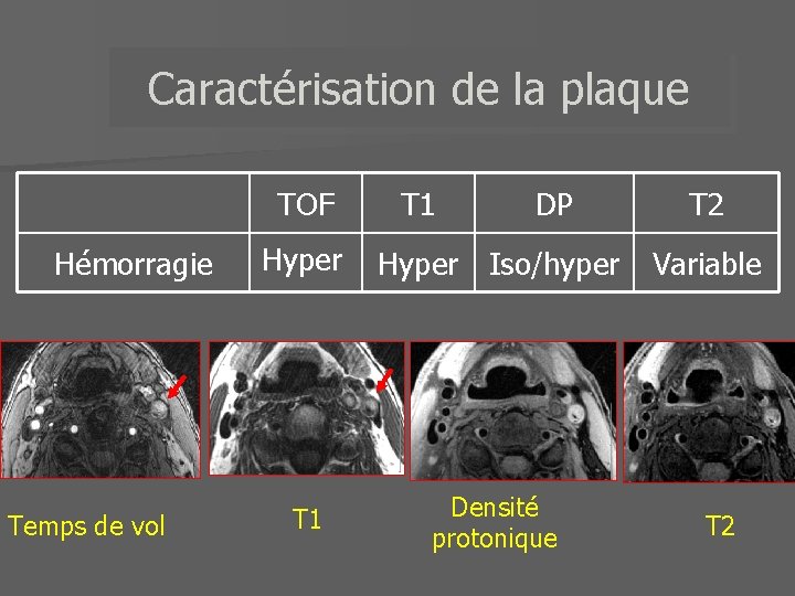 Caractérisation de la plaque TOF Hémorragie Temps de vol Hyper T 1 DP T