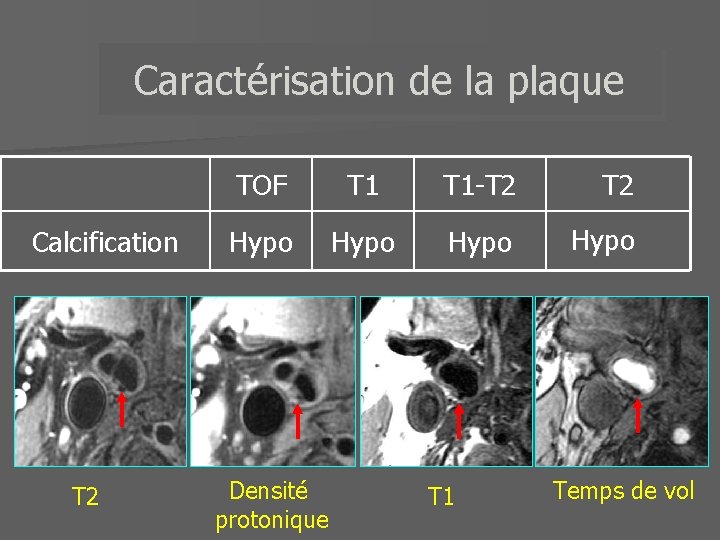 Caractérisation de la plaque Calcification T 2 TOF T 1 -T 2 Hypo Densité