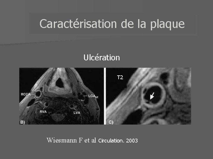 Caractérisation de la plaque Ulcération T 2 Wiesmann F et al Circulation. 2003 