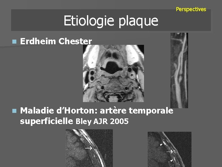Etiologie plaque Perspectives n Erdheim Chester n Maladie d’Horton: artère temporale superficielle Bley AJR