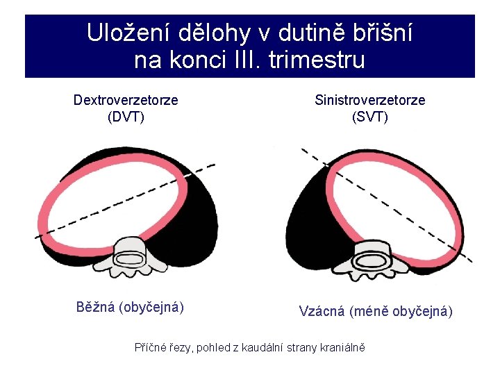 Uložení dělohy v dutině břišní na konci III. trimestru Dextroverzetorze (DVT) Běžná (obyčejná) Sinistroverzetorze