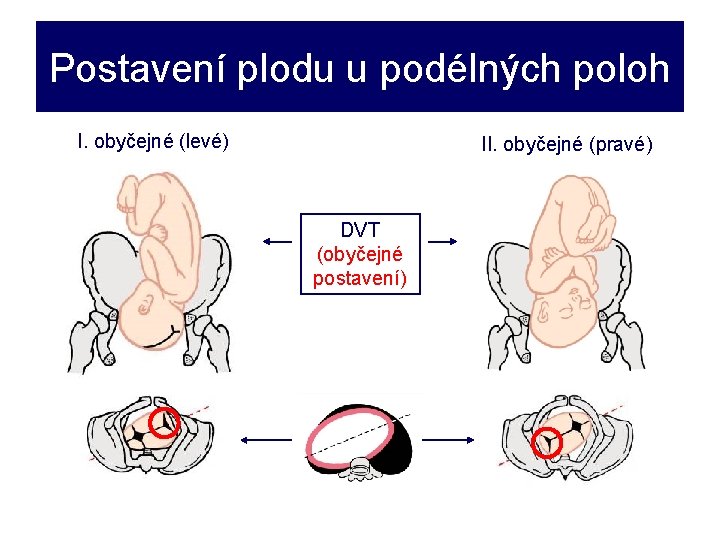 Postavení plodu u podélných poloh I. obyčejné (levé) II. obyčejné (pravé) DVT (obyčejné postavení)