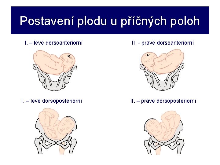 Postavení plodu u příčných poloh I. – levé dorsoanteriorní I. – levé dorsoposteriorní II.