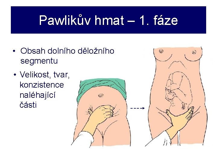 Pawlikův hmat – 1. fáze • Obsah dolního děložního segmentu • Velikost, tvar, konzistence